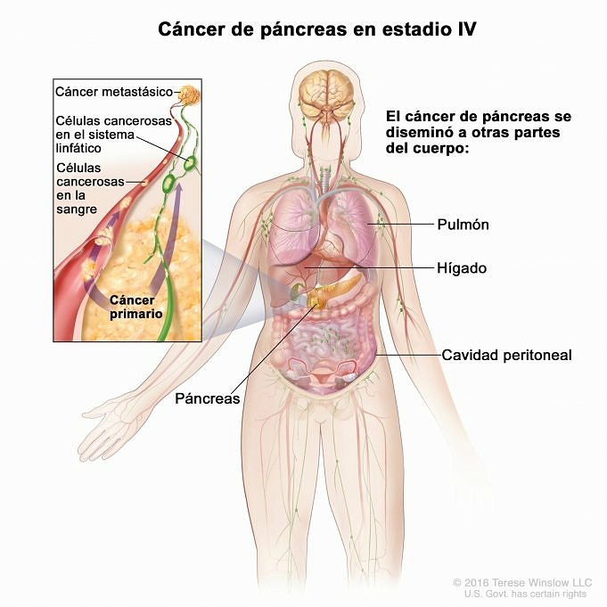 Cancerologia Del Cancro Al Pancreas