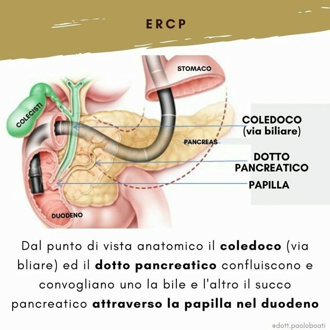 Che Cos'è Il Cateterismo Biliare ERCP?